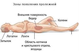 Профилактика пролежней
